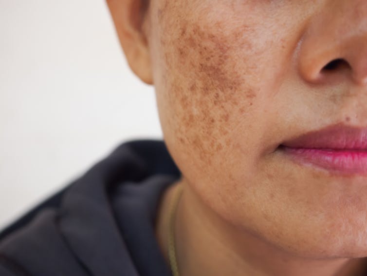 Woman with skin pigmentation on cheek